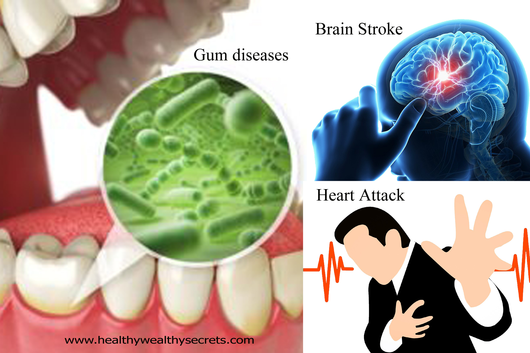 If anyone doesn't brush their teeth correctly, be warned it may lead to a brain stroke.