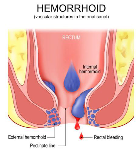 Piles or Hemorrhoids